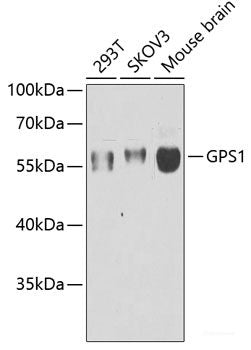 Immunohistochemistry of paraffin-embedded Human liver cancer using VTI1B Polyclonal Antibody at dilution of  1:100 (40x lens).