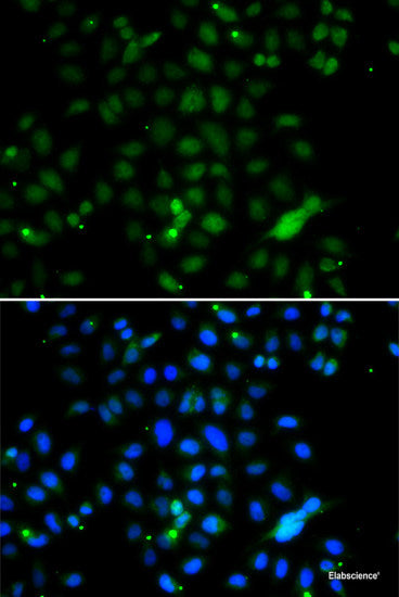 Immunohistochemistry of paraffin-embedded Human brain cancer using ZNF20 Polyclonal Antibody at dilution of  1:100 (40x lens).