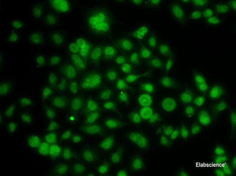 Immunohistochemistry of paraffin-embedded Human liver cancer using SHBG Polyclonal Antibody at dilution of  1:100 (40x lens).