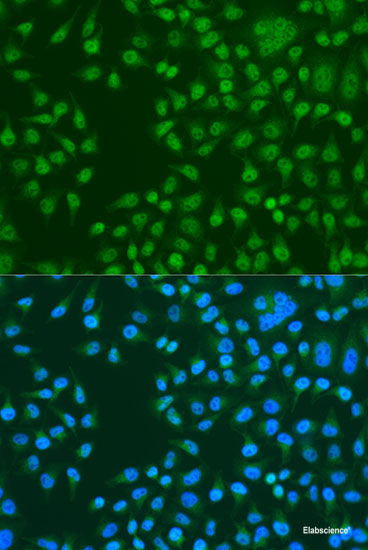 Immunohistochemistry of paraffin-embedded Human lung cancer using ARFIP2 Polyclonal Antibody at dilution of  1:100 (40x lens).