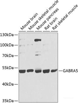 Immunohistochemistry of paraffin-embedded Human breast carcinoma using Phospho-GSK3B（Y216）/GSK3A（Y279）Polyclonal Antibody