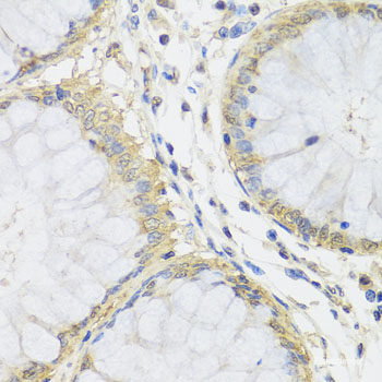 Immunohistochemistry of paraffin-embedded Human liver damage using CETN3 Polyclonal Antibody at dilution of  1:100 (40x lens).