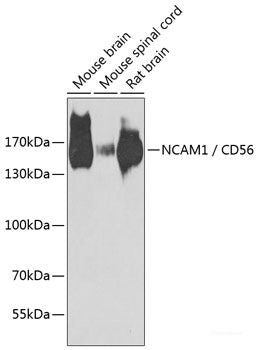 Immunohistochemistry of paraffin-embedded Human liver cancer using CEACAM7 Polyclonal Antibody at dilution of  1:100 (40x lens).