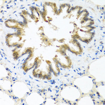 Immunohistochemistry of paraffin-embedded Human liver cancer using CD31 Polyclonal Antibody at dilution of  1:100 (40x lens).