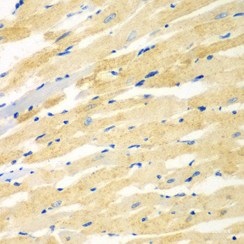 Immunohistochemistry of paraffin-embedded Human brain cancer using PIK3R3 Polyclonal Antibody at dilution of  1:100 (40x lens).