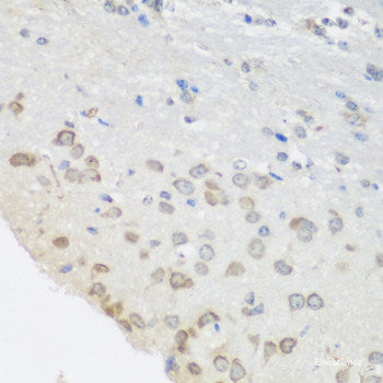 Immunohistochemistry of paraffin-embedded Human liver cancer using ASL Polyclonal Antibody at dilution of  1:100 (40x lens).