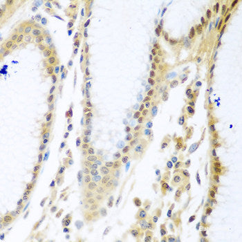 Immunohistochemistry of paraffin-embedded Human kidney cancer using CBFB Polyclonal Antibody at dilution of  1:200 (40x lens).