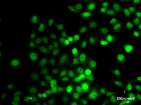 Immunohistochemistry of paraffin-embedded Human breast cancer using KDM6A Polyclonal Antibody at dilution of  1:200 (40x lens).