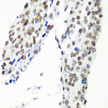 Immunohistochemistry of paraffin-embedded Human liver damage using M6PR Polyclonal Antibody at dilution of  1:100 (40x lens).