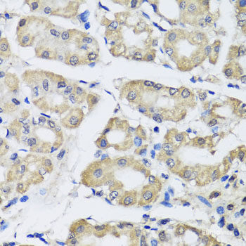 Immunohistochemistry of paraffin-embedded Human oophoroma using TERF2IP Polyclonal Antibody at dilution of  1:100 (40x lens).