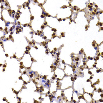 Immunohistochemistry of paraffin-embedded Human liver cancer using TFPI2 Polyclonal Antibody at dilution of  1:200 (40x lens).