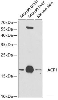 Immunohistochemistry of paraffin-embedded Human esophageal cancer using EXO1 Polyclonal Antibody at dilution of  1:100 (40x lens).