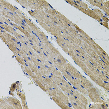 Immunohistochemistry of paraffin-embedded Human breast cancer using MTCH1 Polyclonal Antibody at dilution of  1:100 (40x lens).