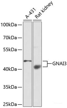 Immunohistochemistry of paraffin-embedded Human liver cancer using IKK beta Polyclonal Antibody at dilution of  1:100 (40x lens).
