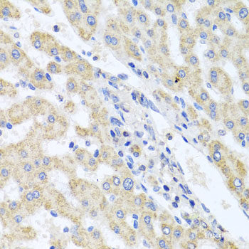 Immunohistochemistry of paraffin-embedded Human colon carcinoma using UBE2S Polyclonal Antibody at dilution of  1:100 (40x lens).