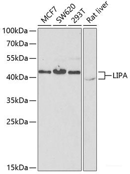 Immunohistochemistry of paraffin-embedded Human liver cancer using CAPNS1 Polyclonal Antibody at dilution of  1:100 (40x lens).