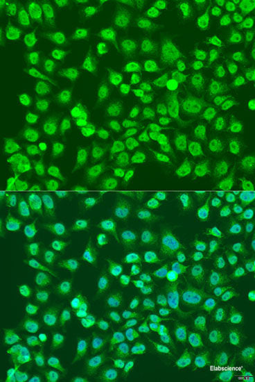 Immunohistochemistry of paraffin-embedded Human lung cancer using MDC1 Polyclonal Antibody at dilution of  1:100 (40x lens).