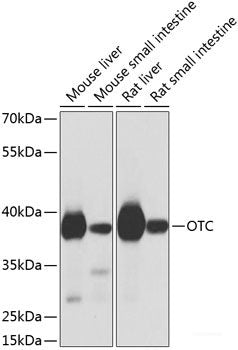 Immunohistochemistry of paraffin-embedded Human gastric cancer using Phospho-γH2A.X(S139) Polyclonal Antibody at dilution of  1:200 (40x lens).