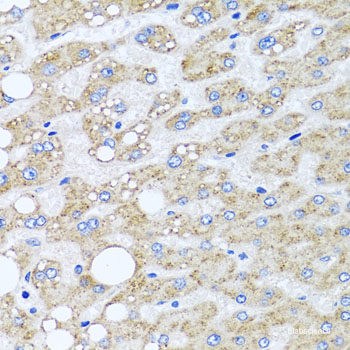 Immunohistochemistry of paraffin-embedded Human liver damage using PSMD8 Polyclonal Antibody at dilution of  1:100 (40x lens).