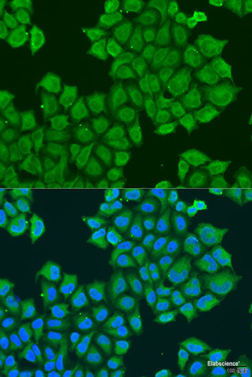 Immunohistochemistry of paraffin-embedded Human uterine cancer using GABPA Polyclonal Antibody at dilution of  1:100 (40x lens).