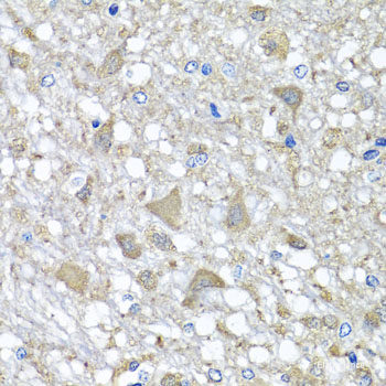 Immunohistochemistry of paraffin-embedded Human liver damage using OSGEPL1 Polyclonal Antibody at dilution of  1:100 (40x lens).