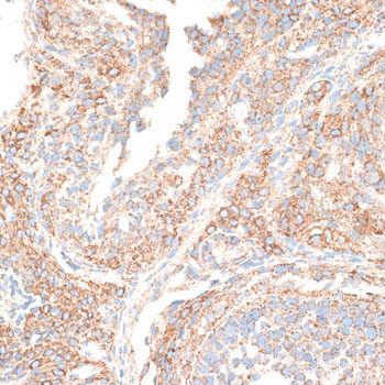 Immunohistochemistry of paraffin-embedded Human prostate using RNASE11 Polyclonal Antibody at dilution of  1:100 (40x lens).
