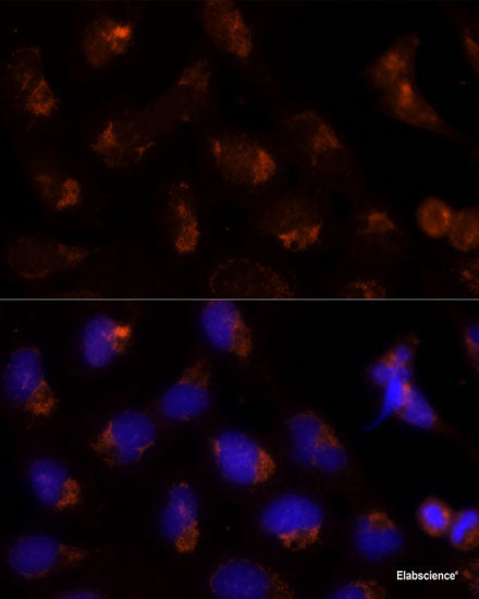 Immunohistochemistry of paraffin-embedded Human prostate cancer using BMP4 Polyclonal Antibody at dilution of  1:100 (40x lens).