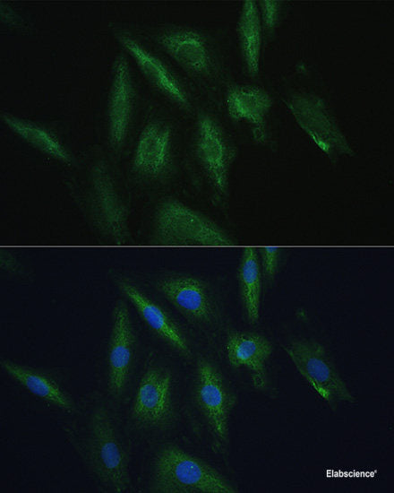 Immunohistochemistry of paraffin-embedded Human lung cancer using Caspase-3 Polyclonal Antibody at dilution of  1:100 (40x lens).