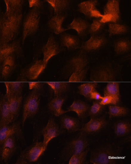 Immunohistochemistry of paraffin-embedded Human breast cancer using BRCA1 Polyclonal Antibody at dilution of  1:100 (40x lens).