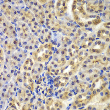 Immunohistochemistry of paraffin-embedded Human liver cancer using GAS2 Polyclonal Antibody at dilution of  1:200 (40x lens).
