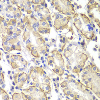 Immunohistochemistry of paraffin-embedded Human liver cancer using AFP Monoclonal Antibody at dilution of  1:12.5 (40x lens).