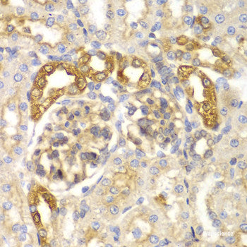 Immunohistochemistry of paraffin-embedded Human lung cancer using FIGF Polyclonal Antibody at dilution of  1:200 (40x lens).