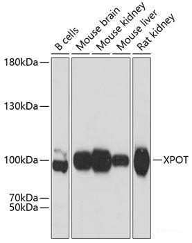 Immunohistochemistry of paraffin-embedded Human lung cancer using ADSS Polyclonal Antibody at dilution of  1:100 (40x lens).