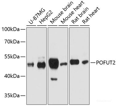 Immunohistochemistry of paraffin-embedded Human liver cancer using Cox2 Polyclonal Antibody at dilution of  1:200 (40x lens).