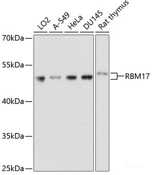 Immunohistochemistry of paraffin-embedded Human colon carcinoma using KRT81 Polyclonal Antibody at dilution of  1:100 (40x lens).