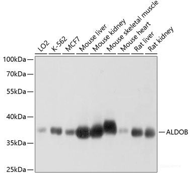 Immunohistochemistry of paraffin-embedded Human gastric cancer using DHX38 Polyclonal Antibody at dilution of  1:150 (40x lens).