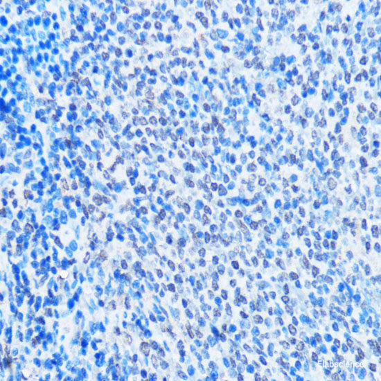 Immunohistochemistry of paraffin-embedded Human lung cancer using RFC5 Polyclonal Antibody at dilution of  1:100 (40x lens).