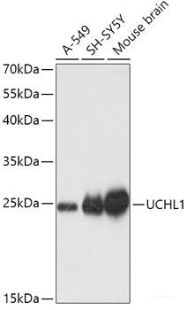Immunohistochemistry of paraffin-embedded Human breast cancer using ATG7 Polyclonal Antibody at dilution of  1:100 (40x lens).