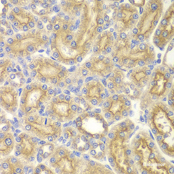Immunohistochemistry of paraffin-embedded Human liver cancer using CytokeRatin-18 Polyclonal Antibody at dilution of  1:100 (40x lens).