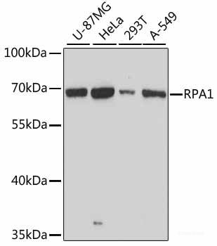 Immunohistochemistry of paraffin-embedded Human lung cancer using TIAM1 Polyclonal Antibody at dilution of  1:100 (40x lens).