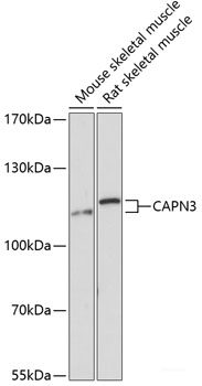 Immunohistochemistry of paraffin-embedded Human liver cancer using TNFSF13 Polyclonal Antibody at dilution of  1:100 (40x lens).