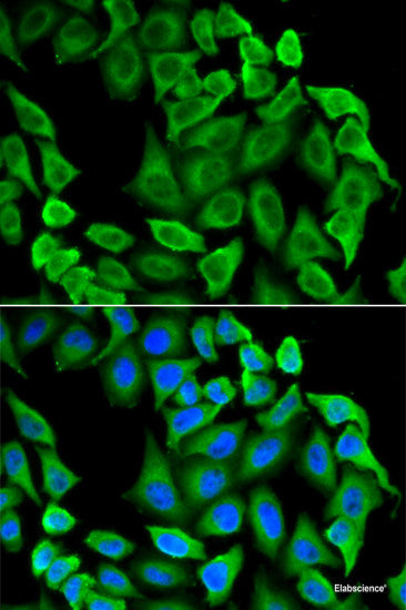 Immunohistochemistry of paraffin-embedded Human mammary cancer using VEGFB Polyclonal Antibody at dilution of  1:200 (40x lens).