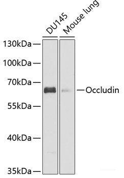 Immunohistochemistry of paraffin-embedded Human colon carcinoma using CLDN4 Polyclonal Antibody at dilution of  1:150 (40x lens).