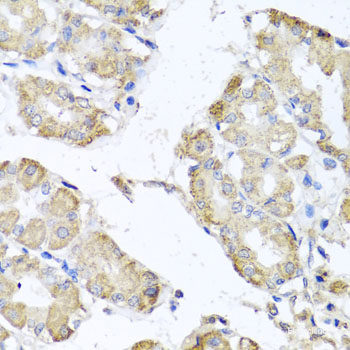 Immunohistochemistry of paraffin-embedded Human lung cancer using DKC1 Polyclonal Antibody at dilution of  1:100 (40x lens).