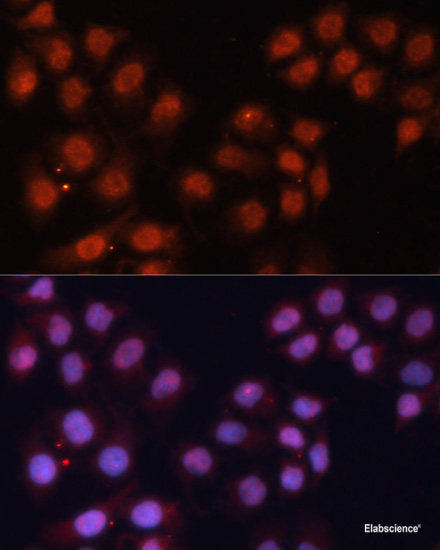 Immunohistochemistry of paraffin-embedded Human liver cancer using ECI2 Polyclonal Antibody at dilution of  1:150 (40x lens).