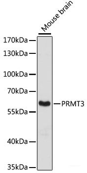 Immunohistochemistry of paraffin-embedded Human oophoroma using CD68 Polyclonal Antibody at dilution of  1:100 (40x lens).
