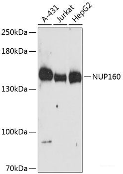 Immunohistochemistry of paraffin-embedded Human gastric cancer using Desmoplakin Polyclonal Antibody at dilution of  1:100 (40x lens).