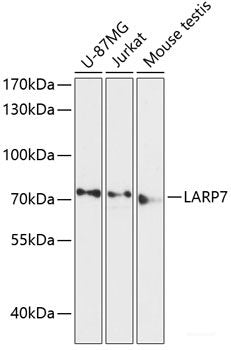 Immunohistochemistry of paraffin-embedded Human liver cancer using HADHA Polyclonal Antibody at dilution of  1:100 (40x lens).