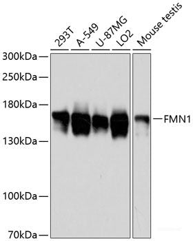 Immunohistochemistry of paraffin-embedded Human gastric cancer using SNCA Polyclonal Antibody at dilution of  1:100 (40x lens).