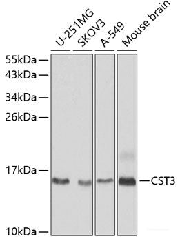 Immunohistochemistry of paraffin-embedded Human liver cancer using ACCS Polyclonal Antibody at dilution of  1:200 (40x lens).